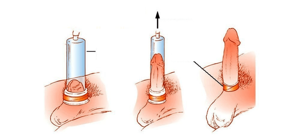 como funciona uma bomba de vácuo para aumento do pênis