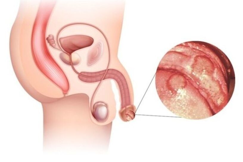 aumento do pênis e glande pequeno