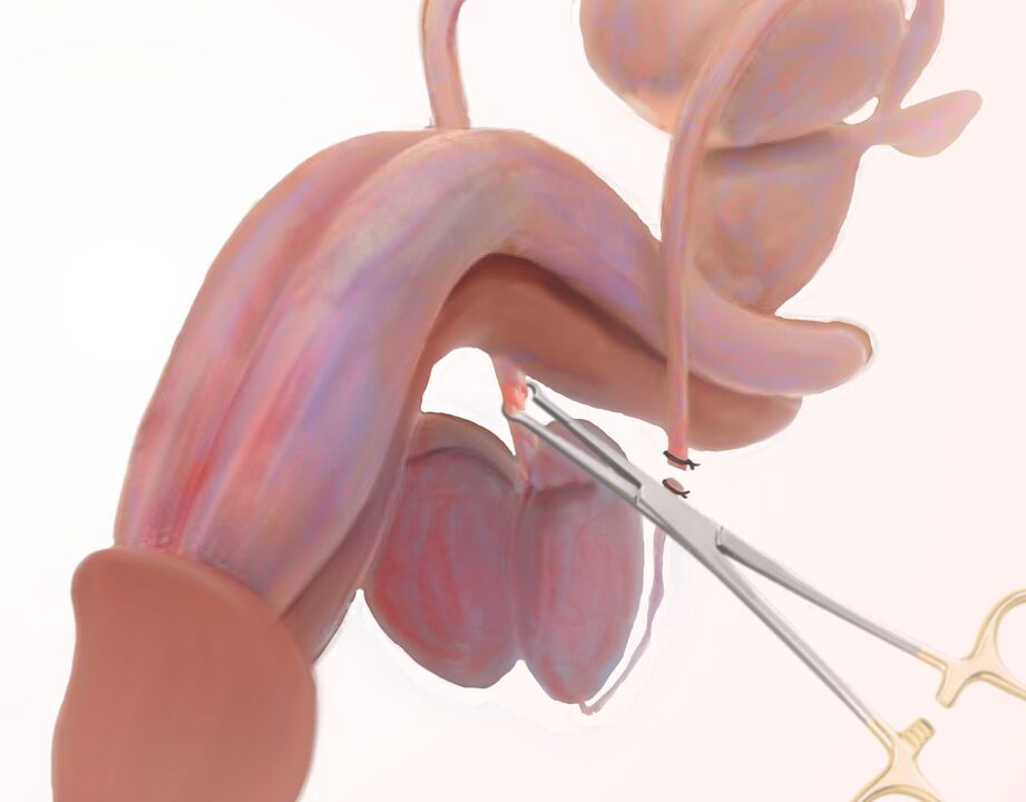 ligamentotomia para aumento do pênis