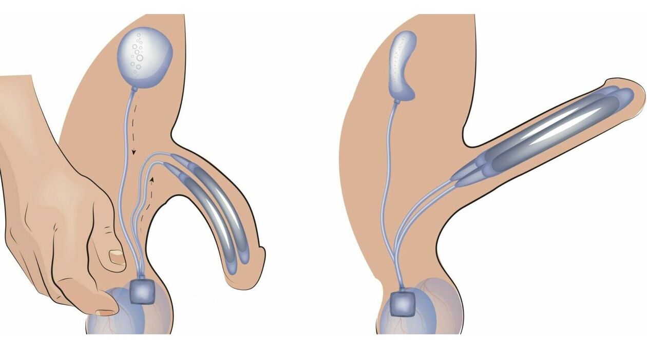 prótese peniana para aumento do pênis